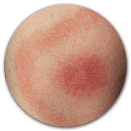 Lyme Disease Testing – Bullseye Rash