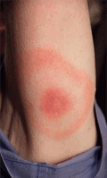 Lyme Disease bullseye rash (erythema migrans)