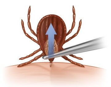Removing a tick with tweezers