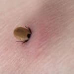 Blacklegged Deer Tick feeding – Lyme disease