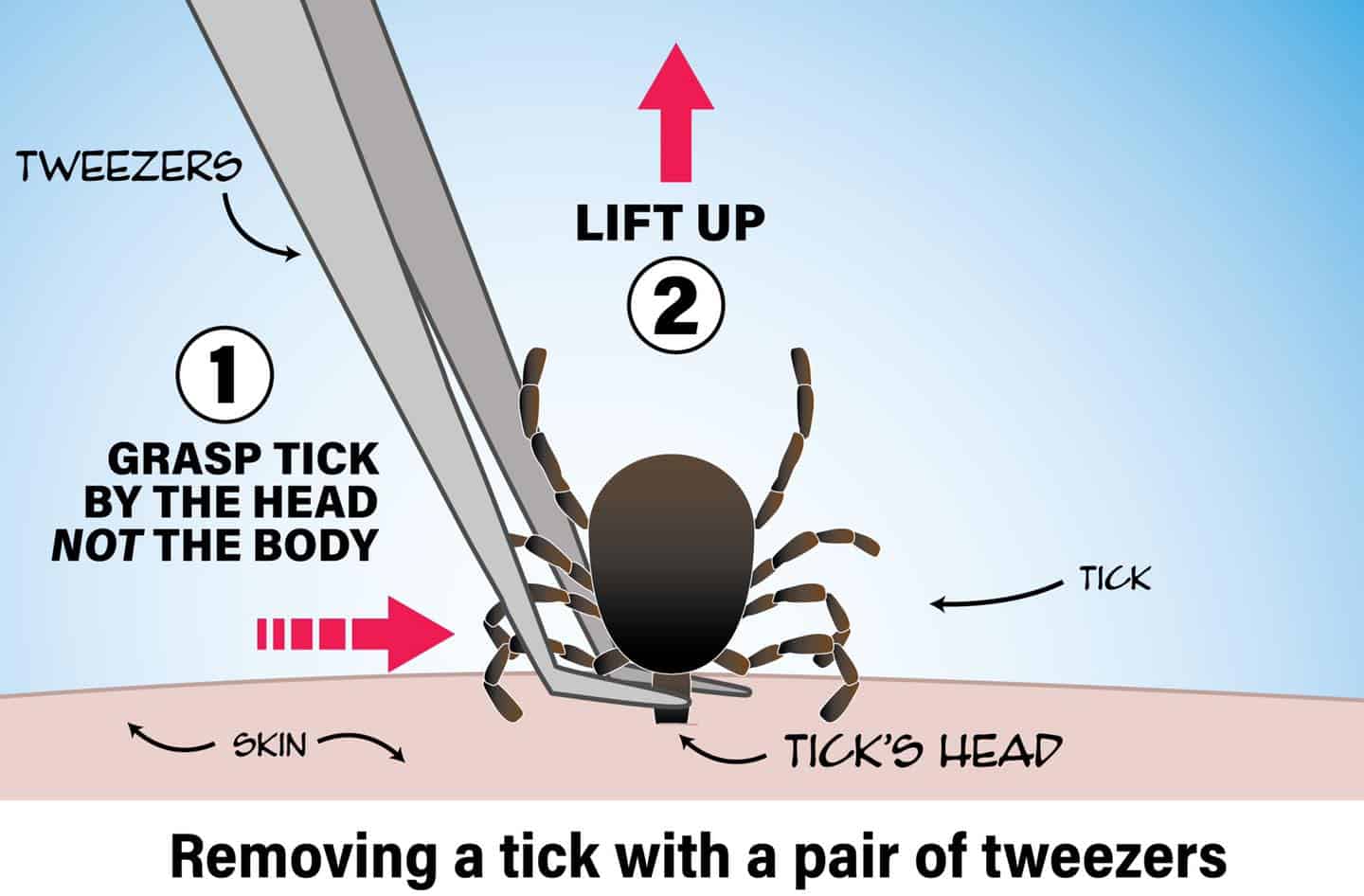 Removing a Tick with a Pair of Tweezers